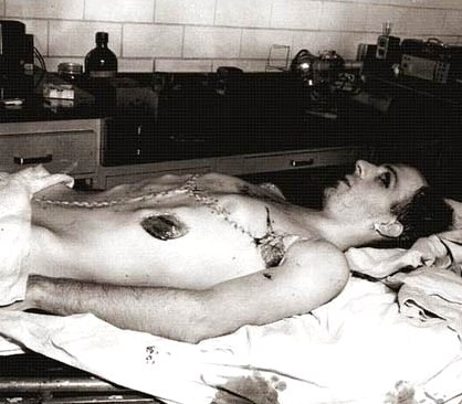 Oswald's Autopsy